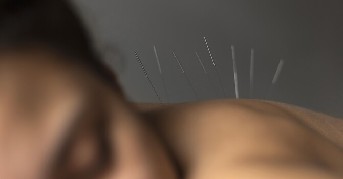 Acupuncture Is More Than Pain Relief
